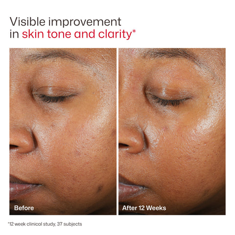 Before and after comparison of skin tone and clarity with text indicating improvement after 12 weeks.