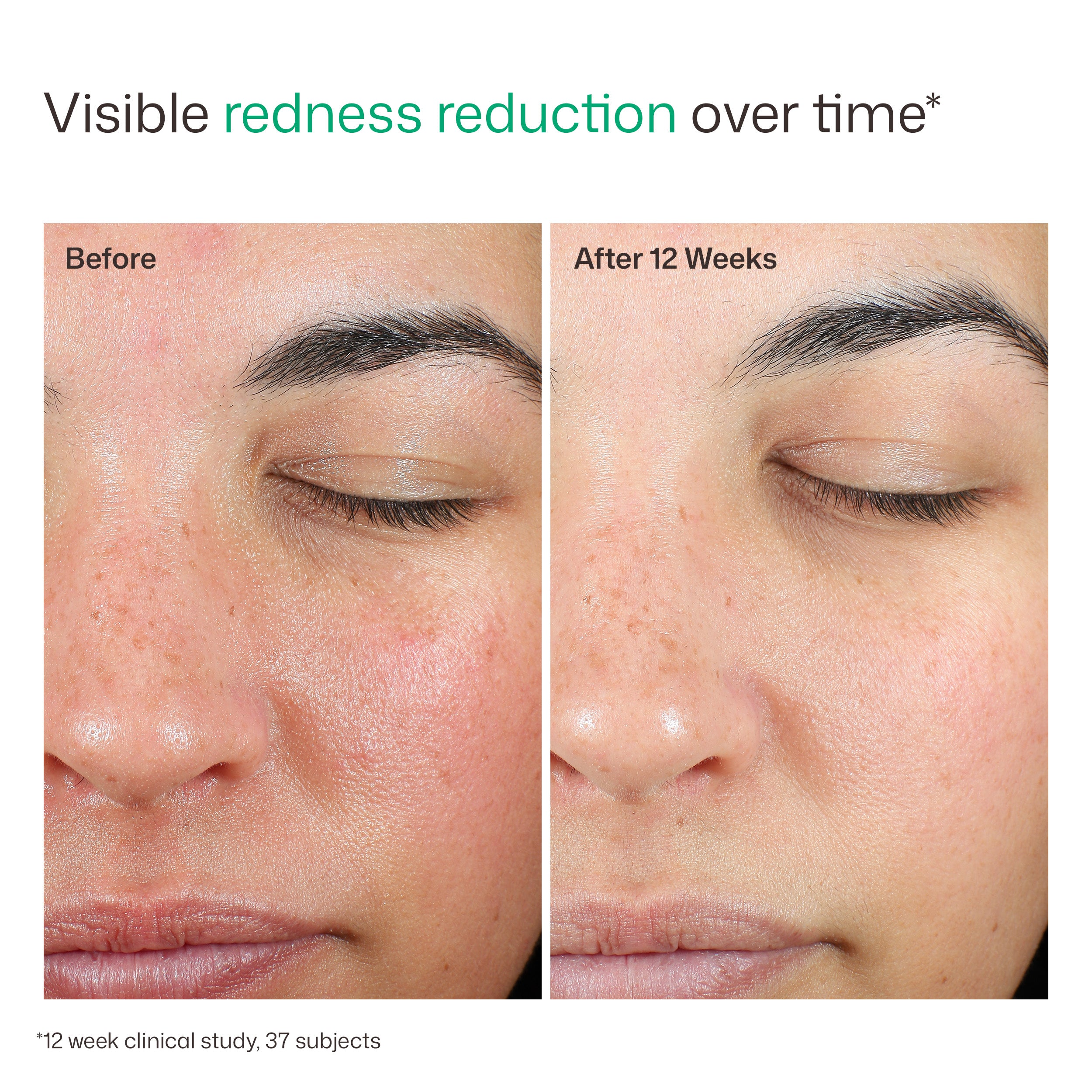 Before and after comparison of visible redness reduction on a person's face over 12 weeks.