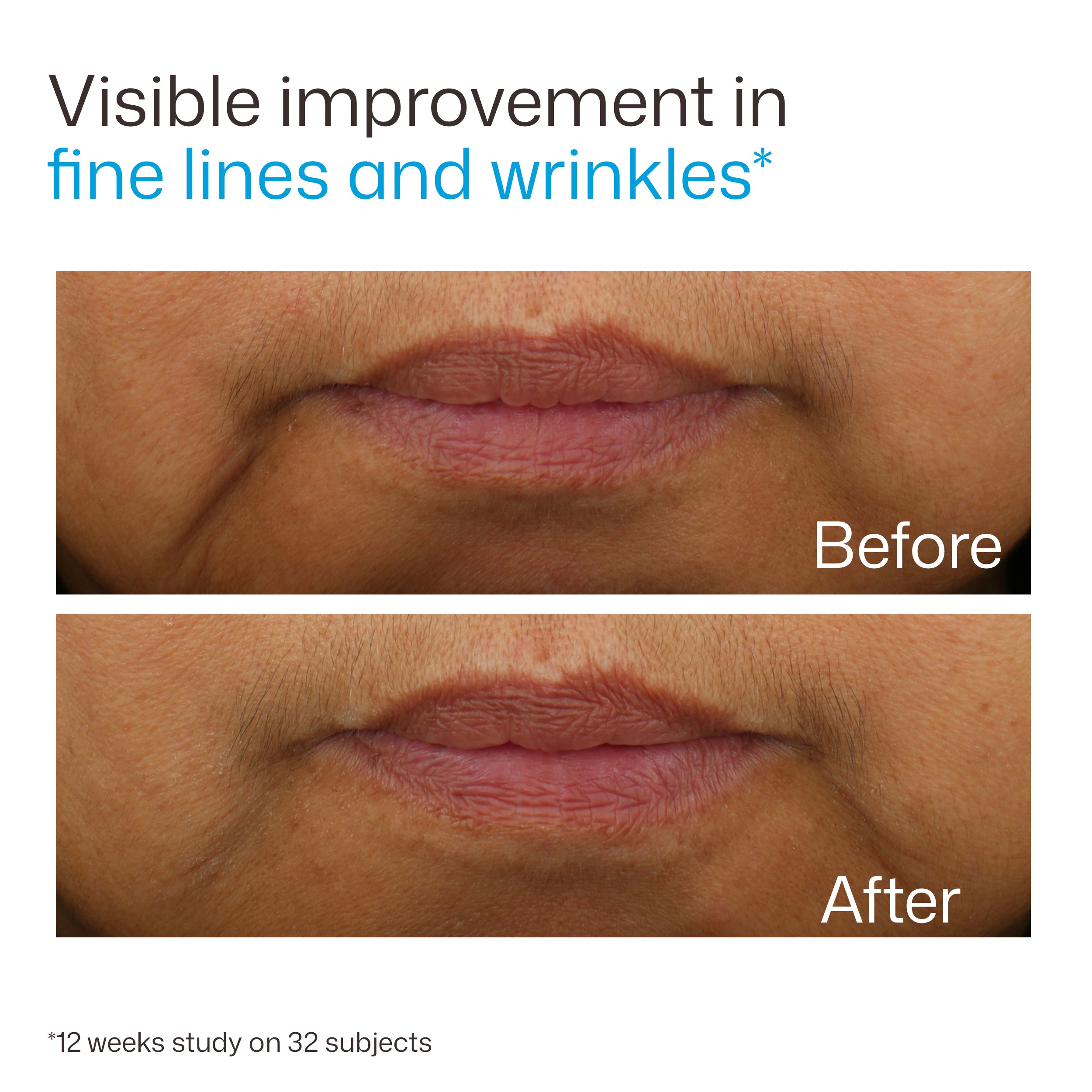 Before-and-after comparison showing the lips of a person with visible fine lines and wrinkles in the top photo and smoother, more relaxed lips in the bottom photo. Text at the top reads 'Visible improvement in fine lines and wrinkles' and 'After' appears on the lower panel.
