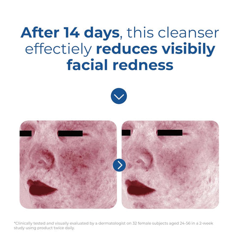 Before and after comparison of facial redness reduction with a cleanser after 14 days.